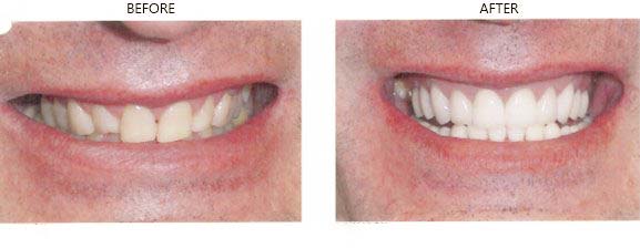 Before and After Smile Makeover